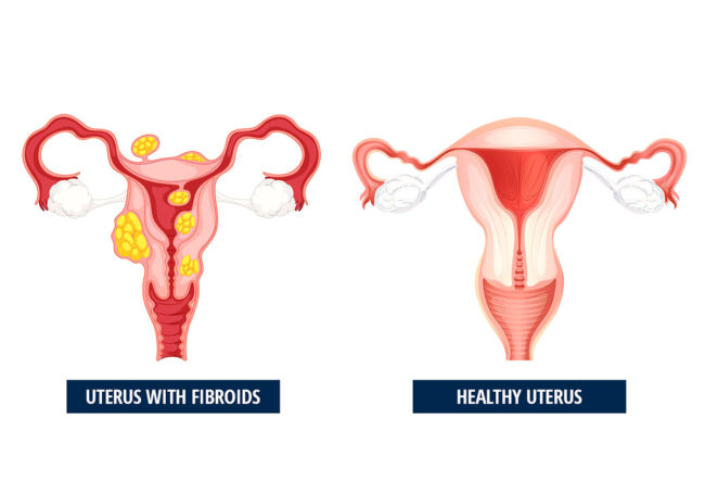 uterine fibroid embolization- UFE -Fibroid Treatment Miami South Florida - Best treatment for uterine fibroids