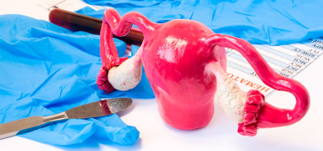 Fibroid Treatment Miami South Florida - avoid a hysterectomy